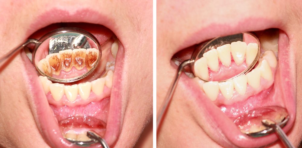 Before and after removal of tartar